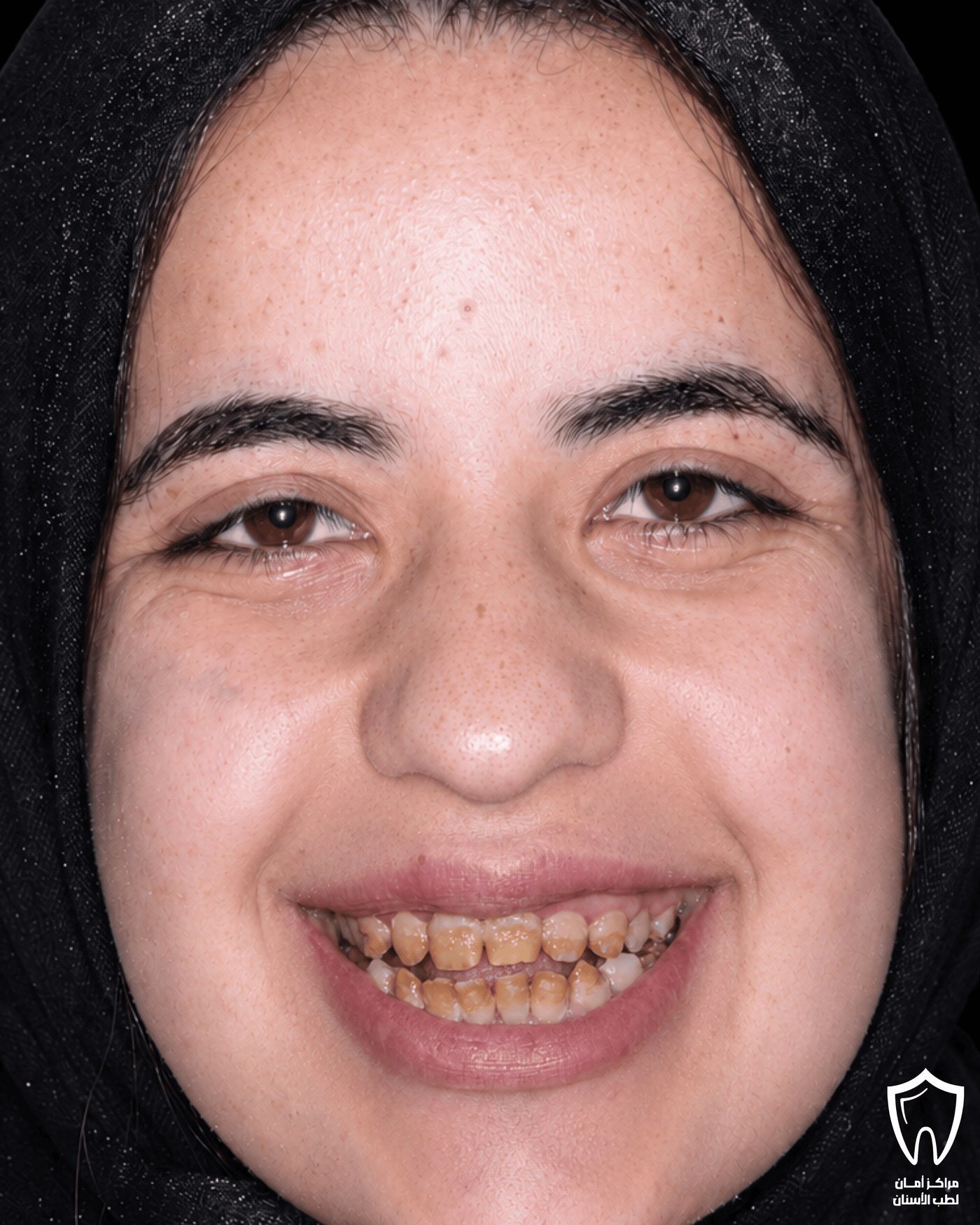إعادة تأهيل الفكين — قبل