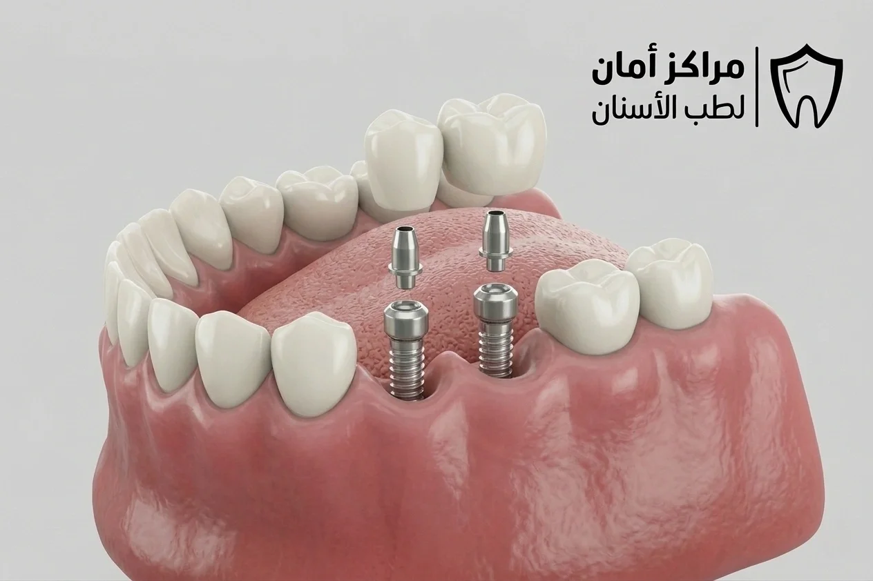 زراعة الاسنان لمرضى السكري: دليلك الكامل لنجاح العملية بأمان