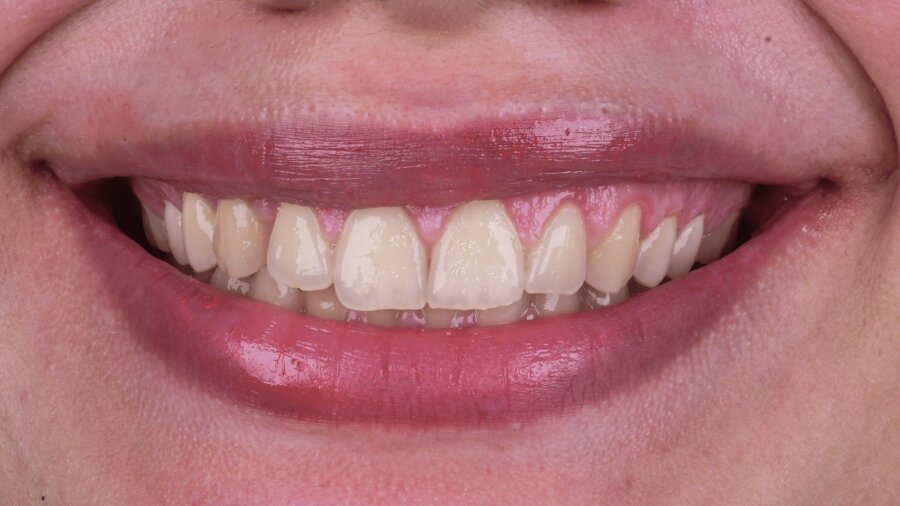 علاج وتجميل اللثة — بعد