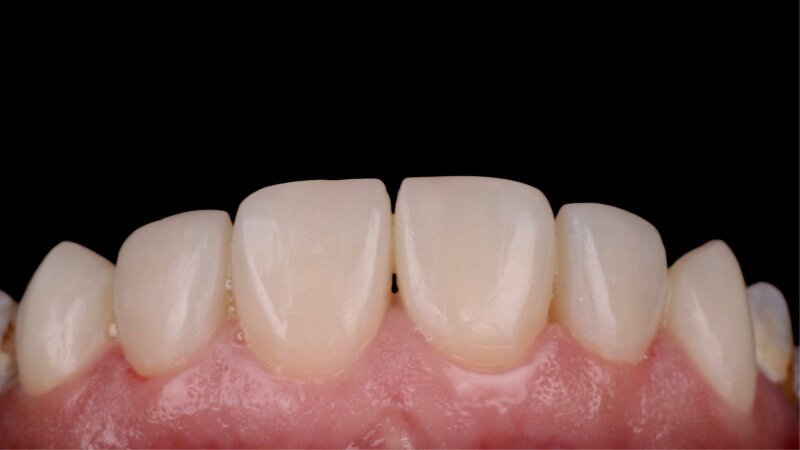 Veneers in Egypt: costs, treatment planning and aftercare