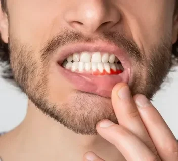 أعراض التهاب اللثة