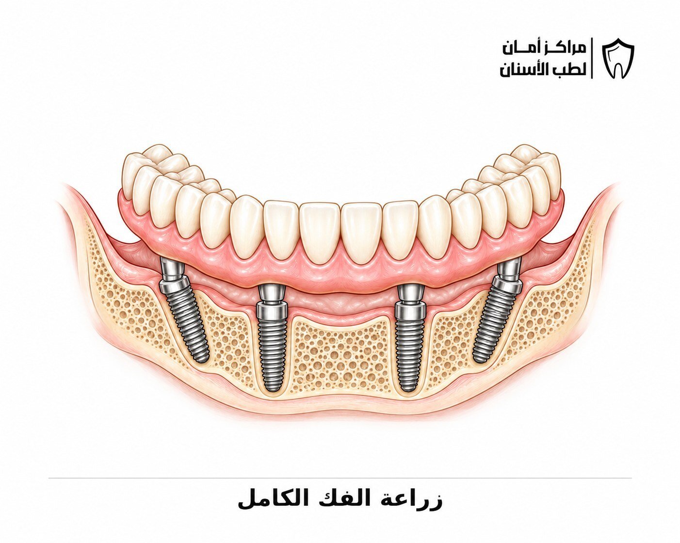زراعة الفك الكامل