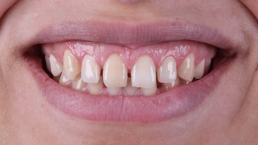 علاج وتجميل اللثة — بعد