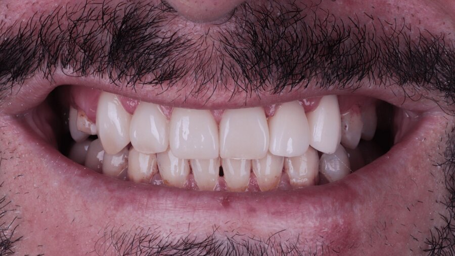 الحشوات التجميلية — بعد