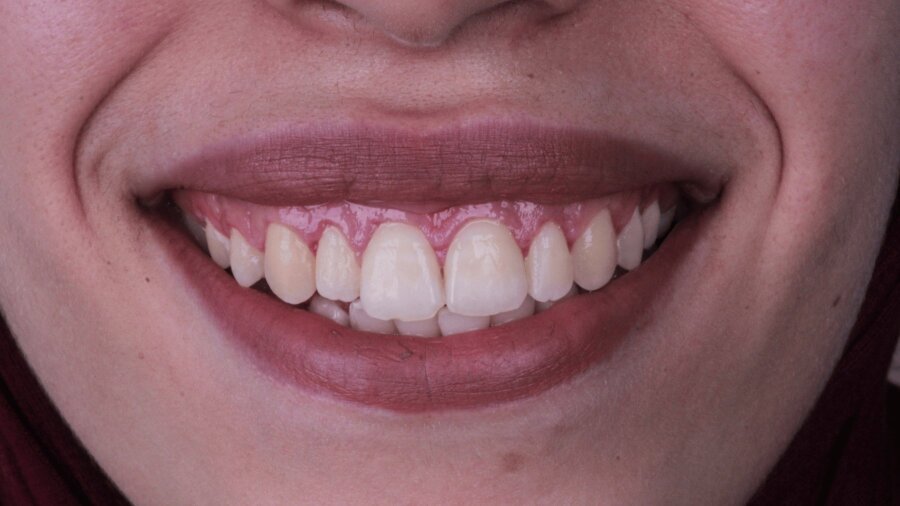 علاج وتجميل اللثة — بعد