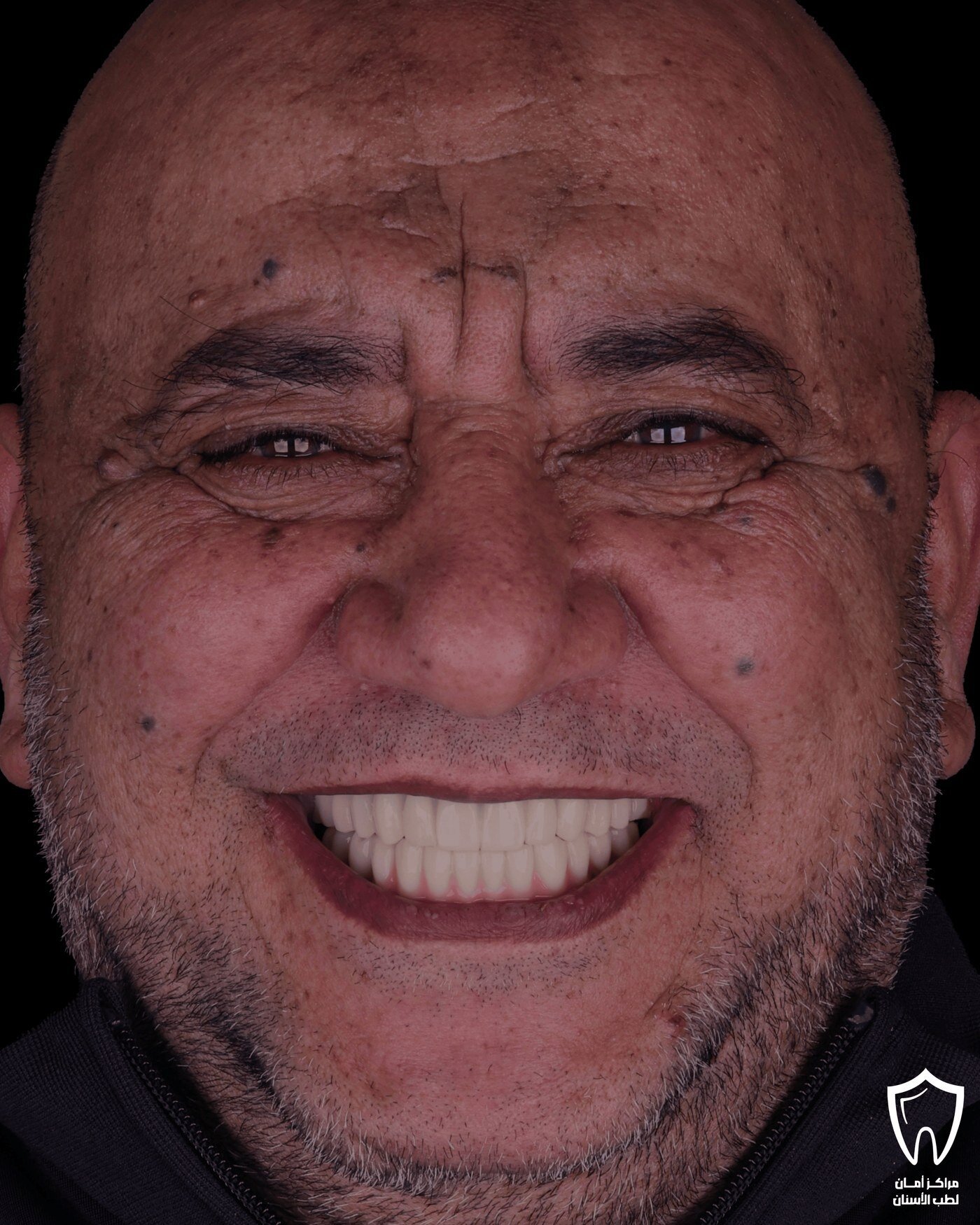زراعة الفك بالكامل — بعد