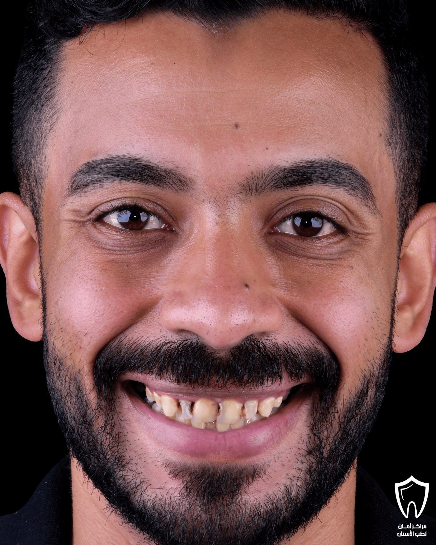 إعادة تأهيل الفكين — قبل