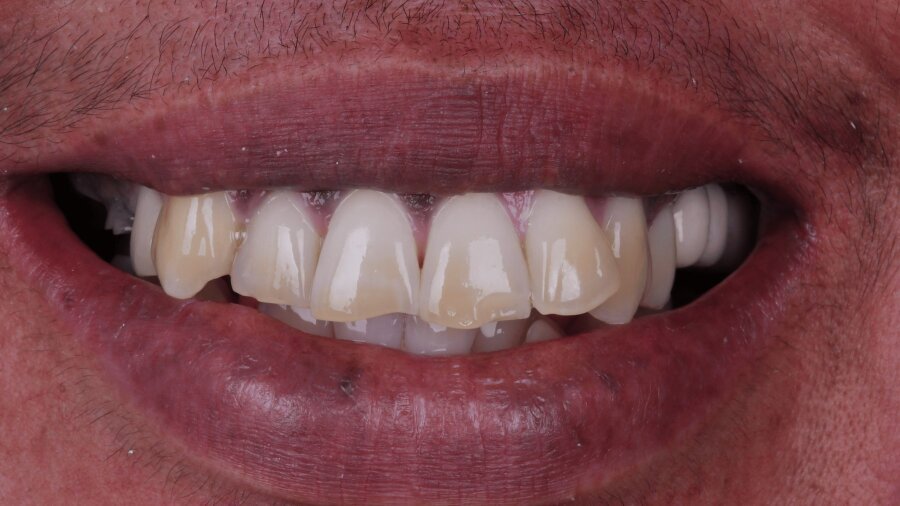 الحشوات التجميلية — قبل