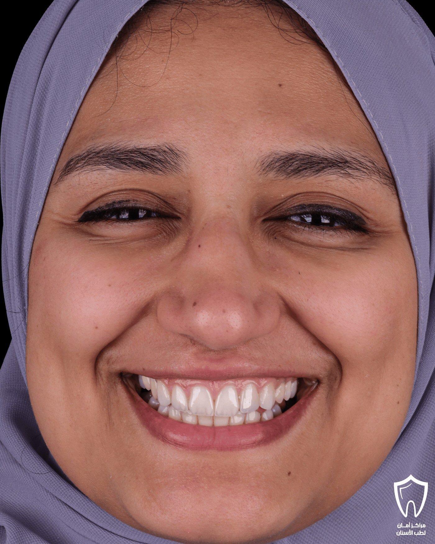 ابتسامة هوليوود — بعد