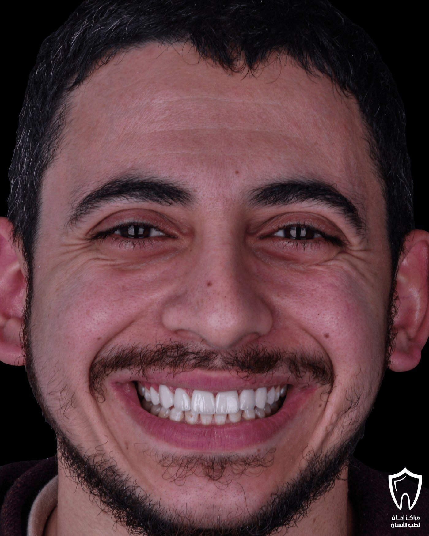 ابتسامة هوليوود — بعد