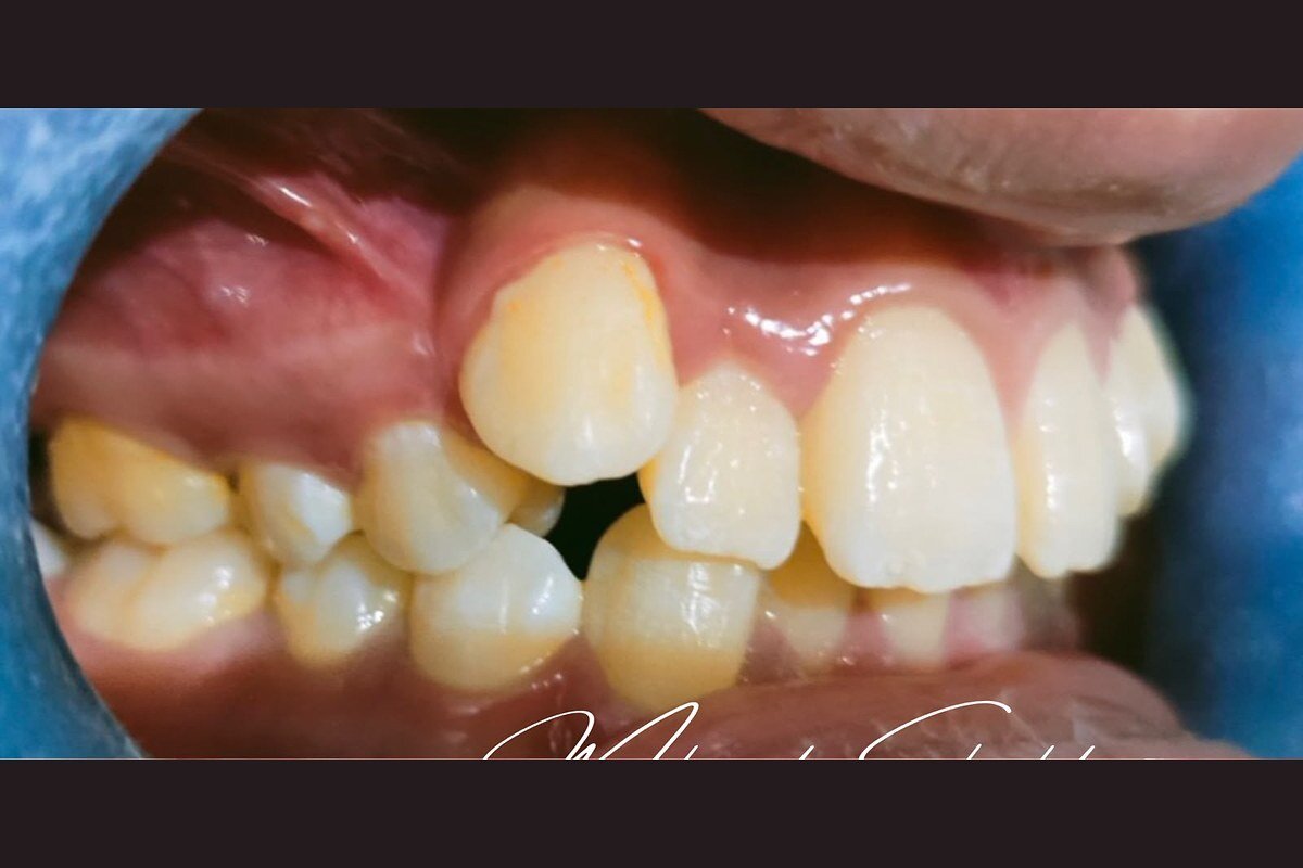 تقويم الأسنان — قبل