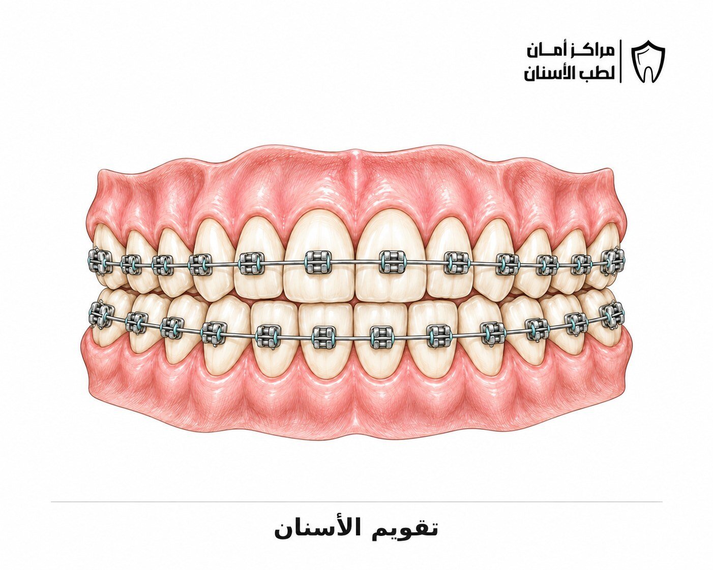 تقويم الأسنان