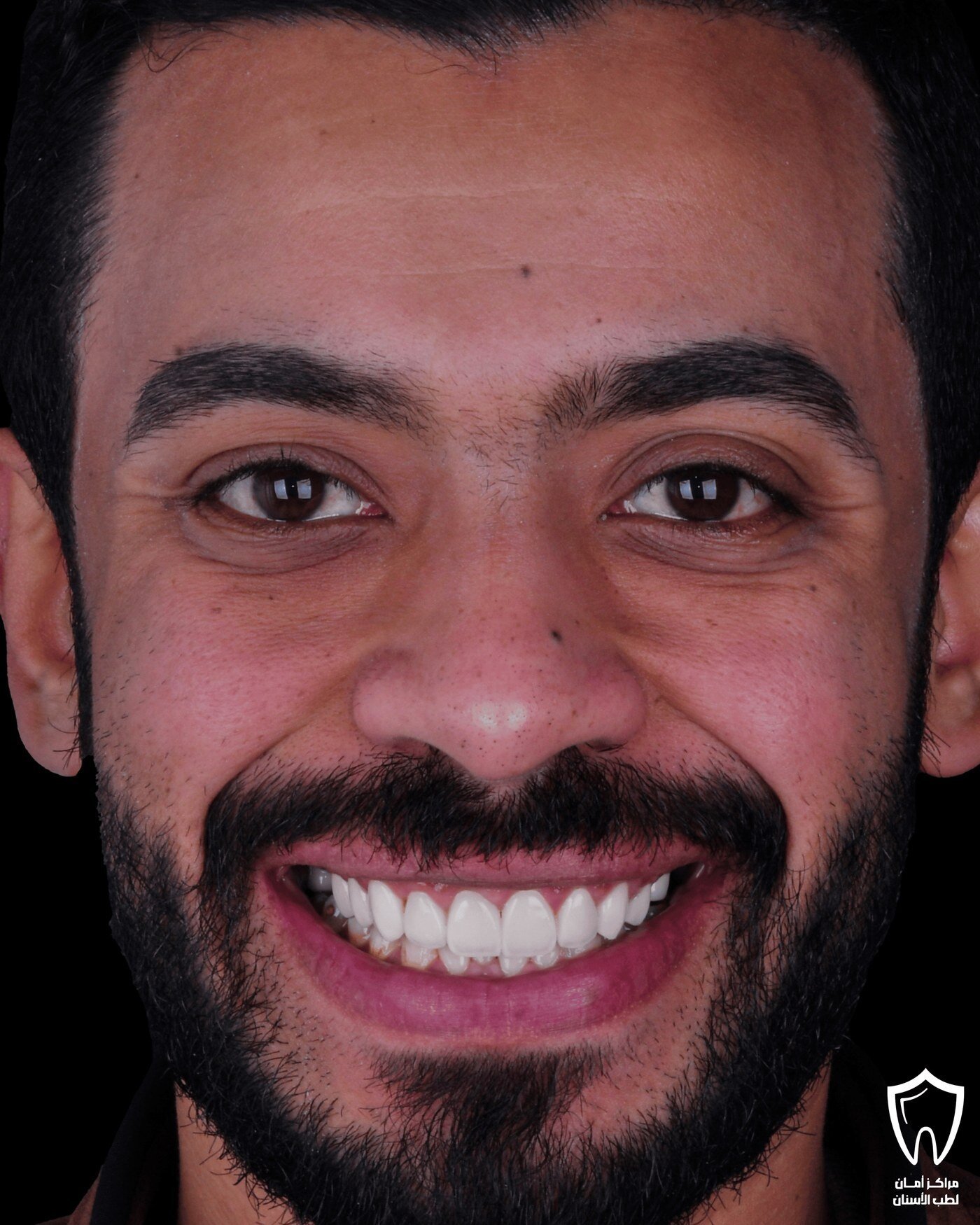 إعادة تأهيل الفكين — بعد