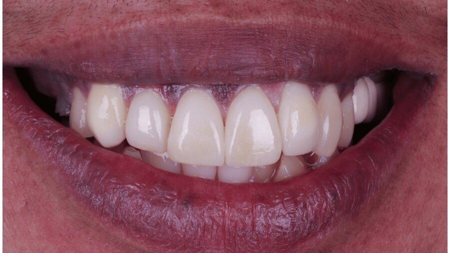 الحشوات التجميلية — بعد
