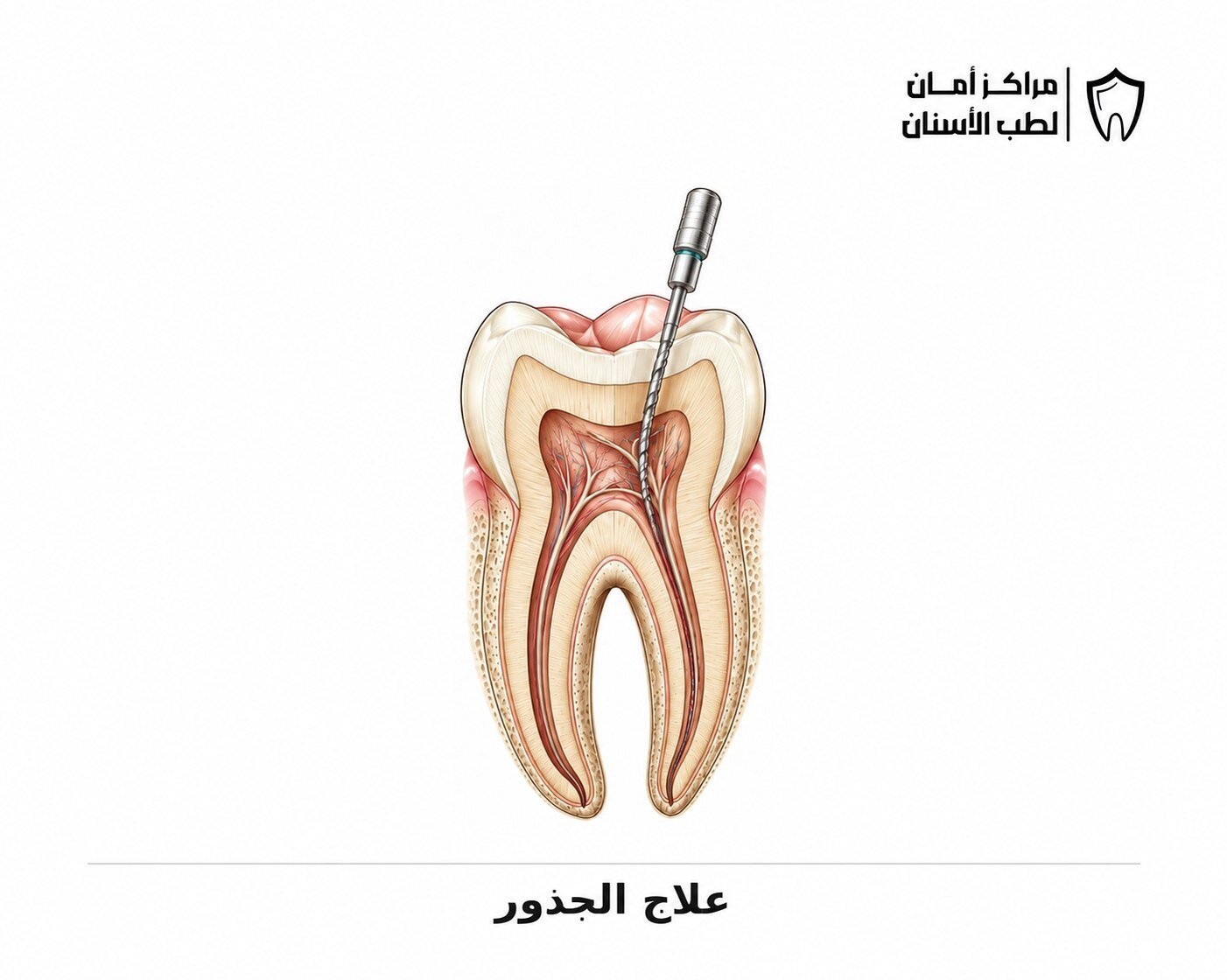 علاج الجذور