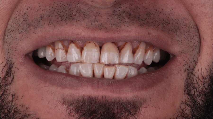 الحشوات التجميلية — قبل