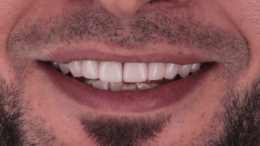 الحشوات التجميلية — بعد