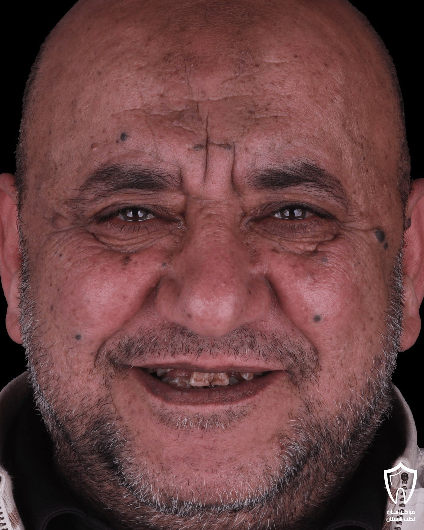 زراعة الفك بالكامل — قبل
