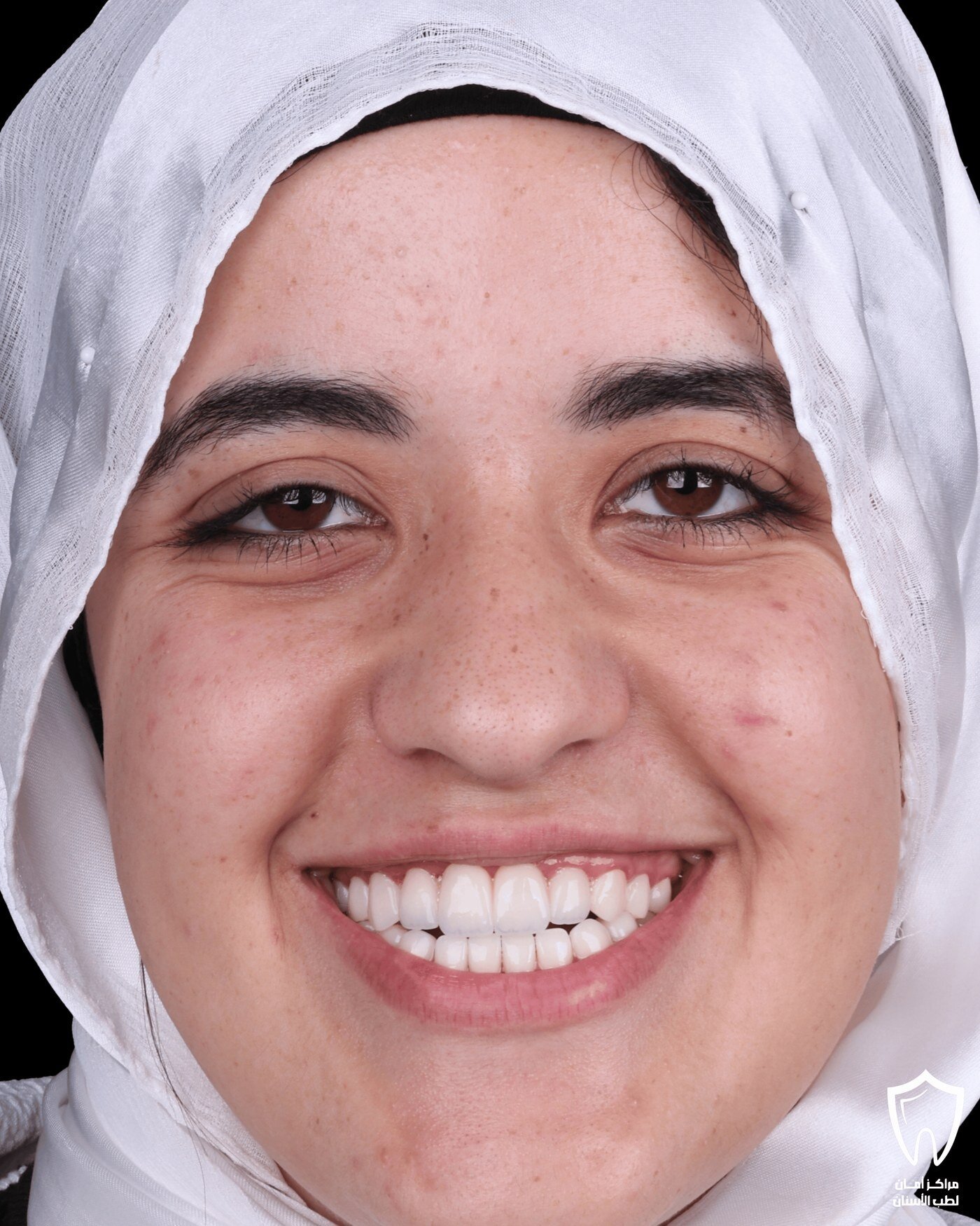 إعادة تأهيل الفكين — بعد